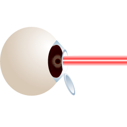 laser vision correction surgery
