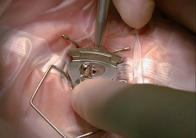 vision correction