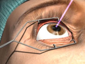 refractive surgery
