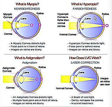 vision correction surgery