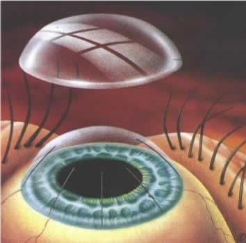 refractive surgery
