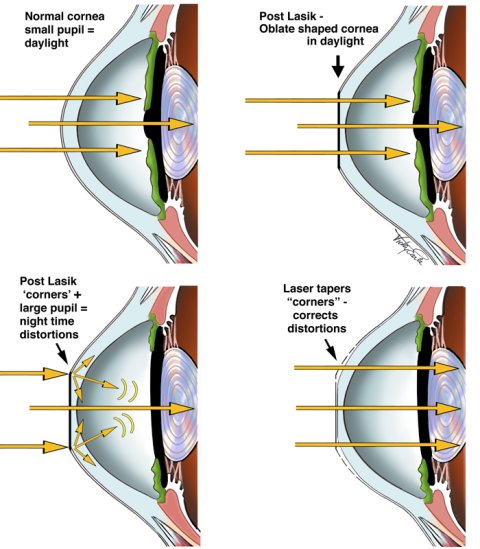 laser vision correction