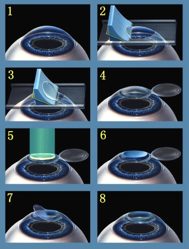 refractive surgery
