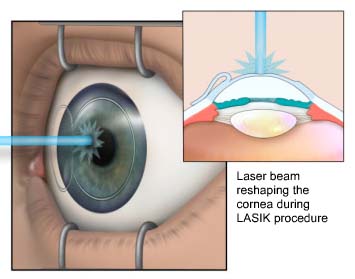 refractive surgery