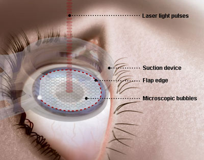 vision correction surgery
