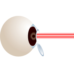 vision correction surgery