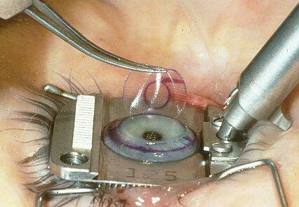 refractive surgery