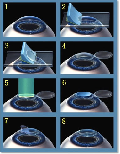 refractive surgery