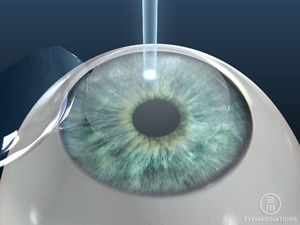 refractive surgery