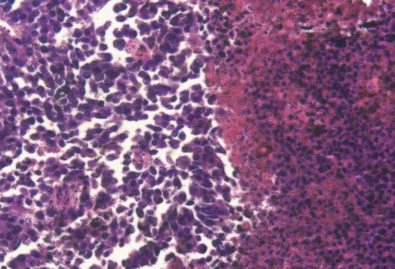 b16 melanoma