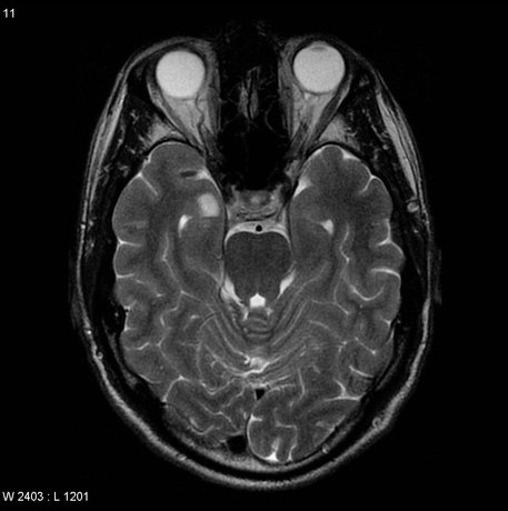 dnet brain tumor