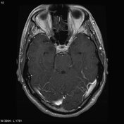dnet brain tumor