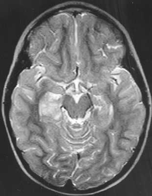 dnet brain tumor