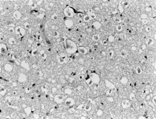 dnet brain tumor