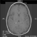 dnet brain tumor