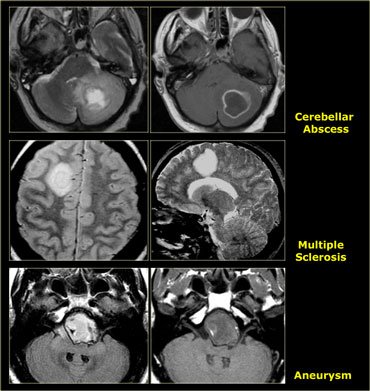 dnet brain tumor