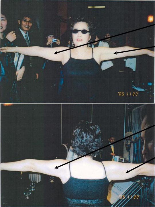 treatment arm