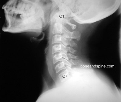 cervical c7
