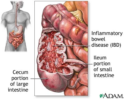 ibd disease