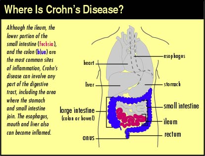 crohn