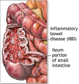 crohn