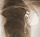 icd pacemaker
