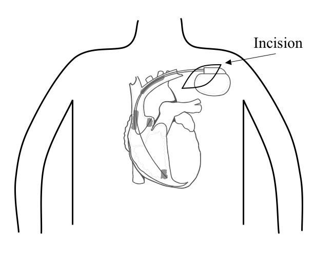 icd pacemaker