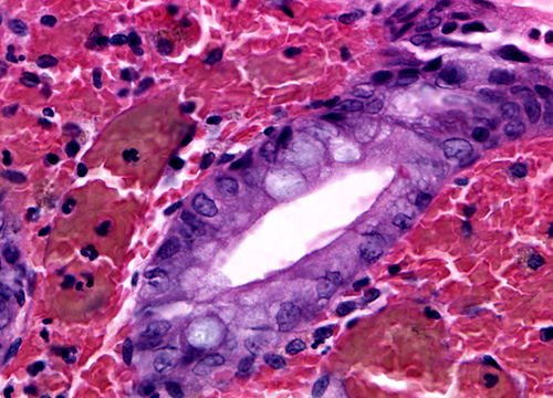 ibd inflammation