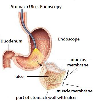 ogd endoscopy