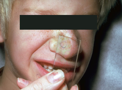 telangiectasia